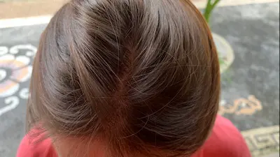 Optavia Hair Loss problems, explained