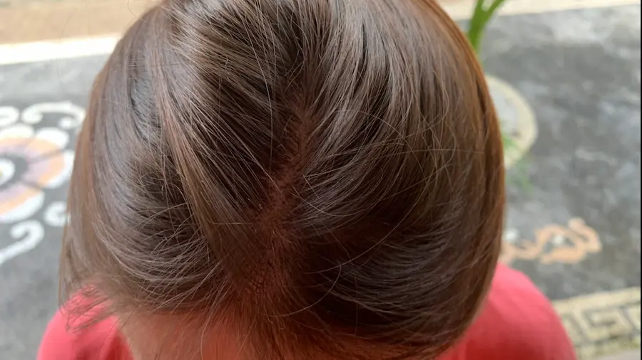 photo of my hair optavia hair loss problems